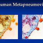 Грипп в новгородских лабораториях на прошлой неделе не выявили, зато обнаружили метапневмовирус