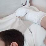 Медики прокомментировали случай с юным новгородцем, который едва не лишился пальца из-за тренажёра