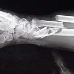 В Пестове восьмиклассник сломал на уроке физкультуры обе руки