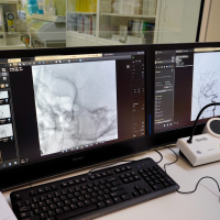 56-летнюю женщину с аневризмой головного мозга спасли новгородские врачи